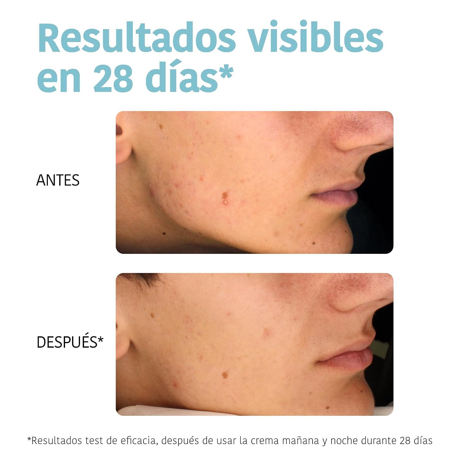 IROHA NATURE — Crème visage anti-imperfections à l’acide salicylique – Image 4